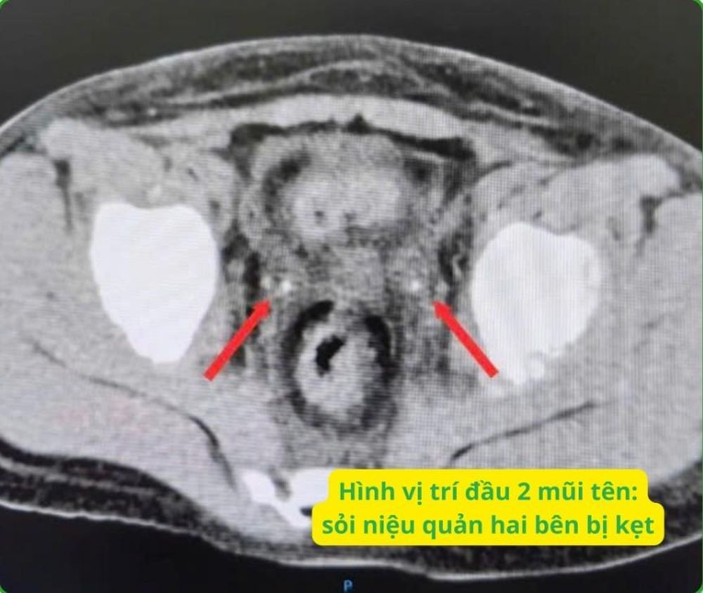 Kẹt sỏi niệu quản ở trẻ sau mổ viêm ruột thừa gây suy thận