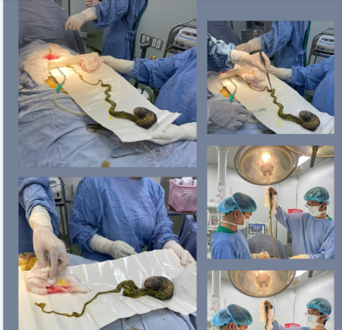 Bác sĩ cảnh báo hiểm họa sức khỏe do trẻ em ăn tóc – không chỉ là nghịch ngợm