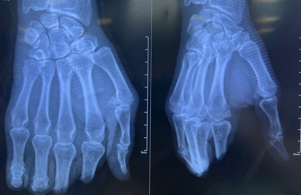 Bệnh viện Nhân dân 115 phẫu thuật vi phẫu cứu 4 ngón tay bị đứt lìa cho người đàn ông