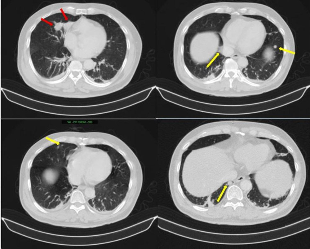 Phát hiện hai ung thư nguyên phát ở cùng một bệnh nhân: Bài học từ chẩn đoán chính xác