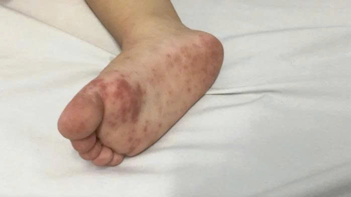 Tay chân miệng gia tăng, đã ghi nhận 8 ca tử vong trong cả nước